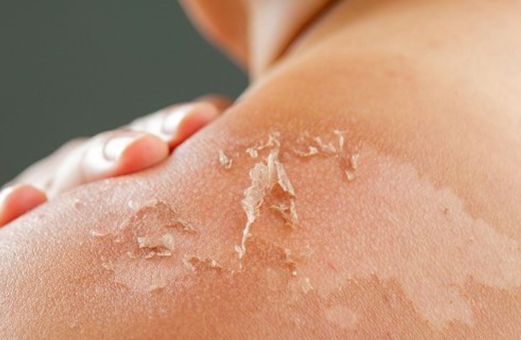 شناسایی مکانیسم کلیدی کنترل کننده بازسازی پوست توسط دانشمندان